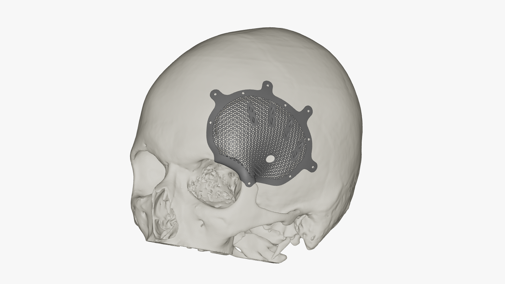 НМИЦ Мешалкина. Индивидуальный костный имплантат для пациента В..png НМИЦ Мешалкина. Индивидуальный костный имплантат для пациента В..png